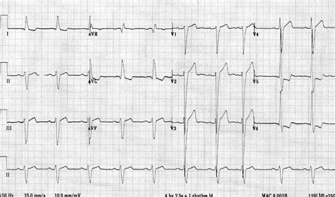 lv kt fb linergy|Left Ventricular Hypertrophy (LVH) • LITFL • ECG Library Diagnosis.